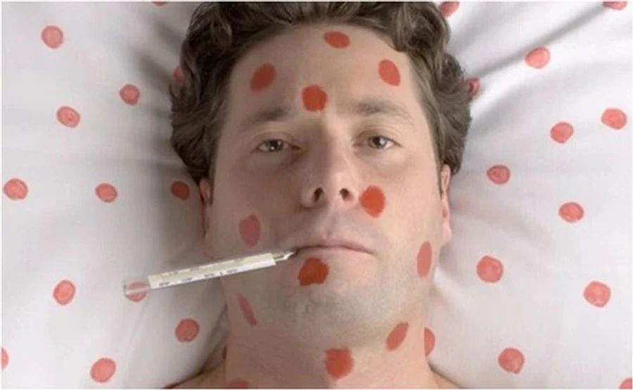 Триває спалах кору: за тиждень захворіли понад 1400 українців - МОЗ