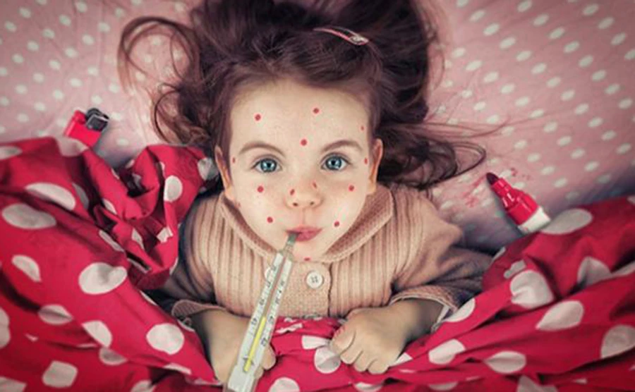 Корь в Украине: Одесса введет онлайн-обучение для тех, у кого нет прививки