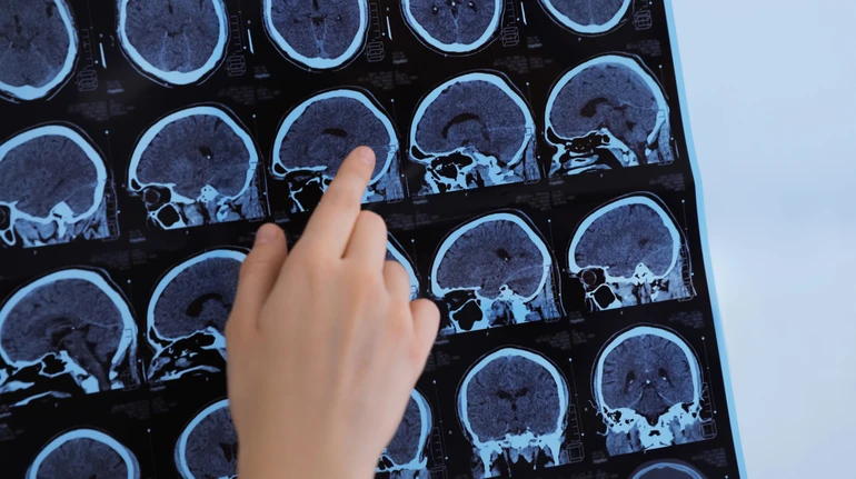 Допоміг ШІ: вчені з Великої Британії виявили два нові підтипи розсіяного склерозу