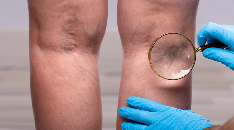 Як розпізнати небезпеку від тромбів: пояснення судинного лікаря