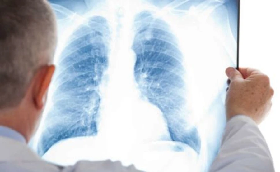 Двох людей, які приїхали з Італії, госпіталізували з пневмонією в Чернівцях