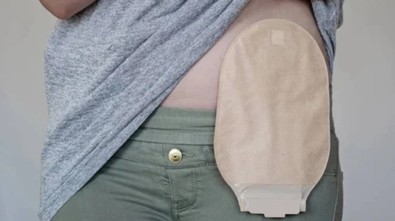 Шанс продовжувати життя, хоч і без шлунка. Історії жінок, які живуть зі стомою