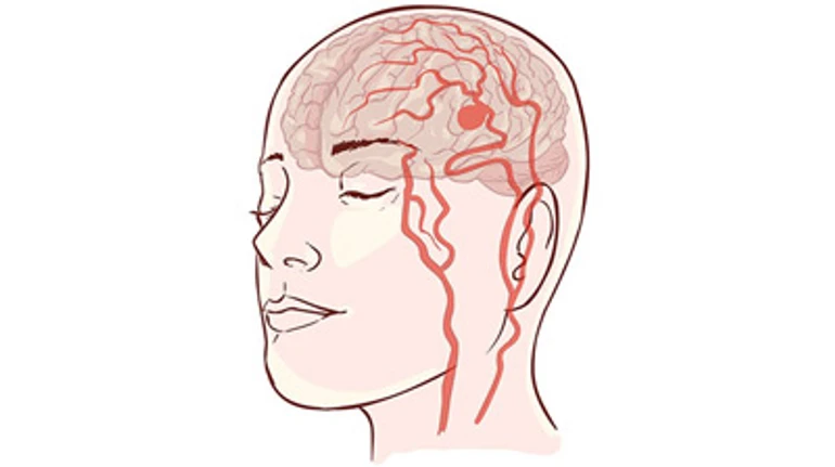 Как это жить с болезнью, которая может оборвать жизнь в любой момент – аневризмой головного мозга