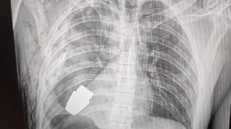 Surgery under sapper’s supervision: doctors retrieve unexploded VOG grenade out of soldier’s body