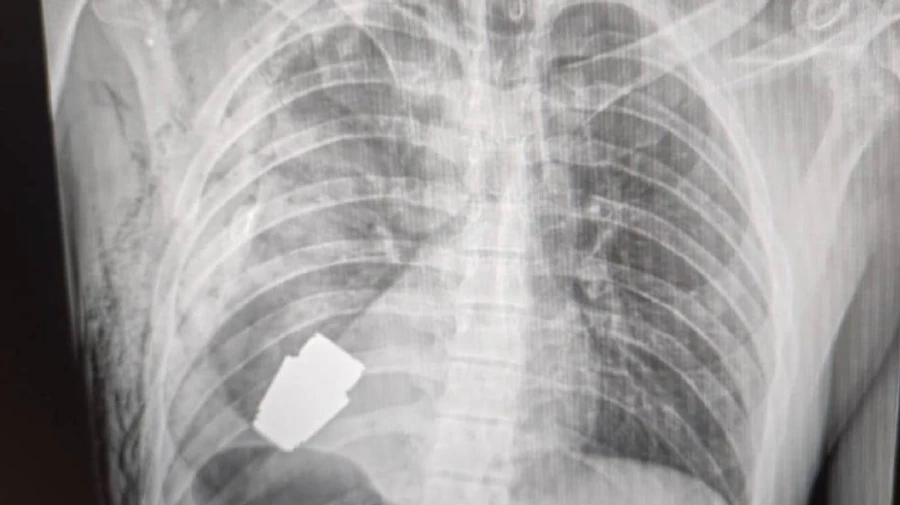 Surgery under sapper’s supervision: doctors retrieve unexploded VOG grenade out of soldier’s body