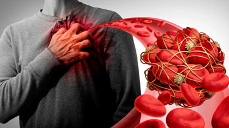 Тромбы после вакцинации AstraZeneca: симптомы, кто в зоне риска и насколько это опасно