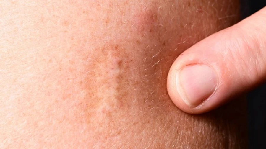 США збільшують запаси вакцини проти мавпячої віспи