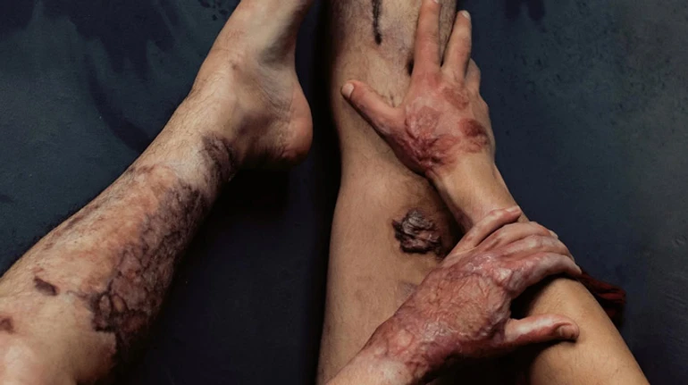 Не лише естетика. Як шрами й рубці заважають жити та як їх лікують в Україні