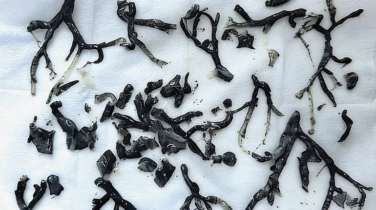 Китайські лікарі дістали з дихальних шляхів літнього чоловіка зліпки його бронхів із сажі