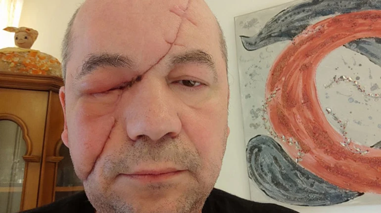 Виходив з міста по трупах. Історія маріупольця, який залишився без ока та втратив рідних