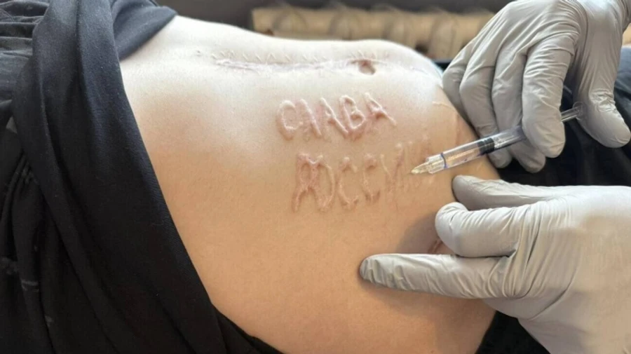 Doctor says removal of Glory to Russia burn mark from Ukrainian POW will be painful