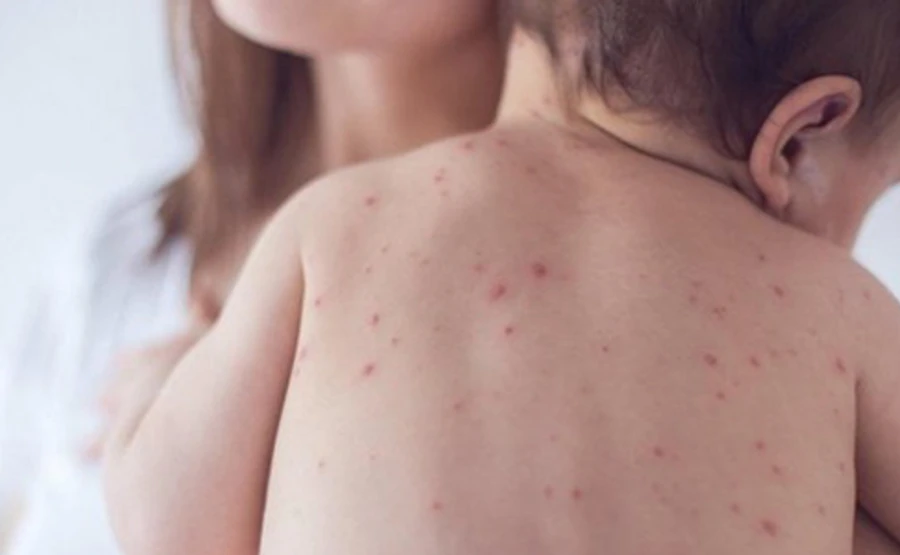 В США выдали предупреждение из-за вспышки кори в Украине