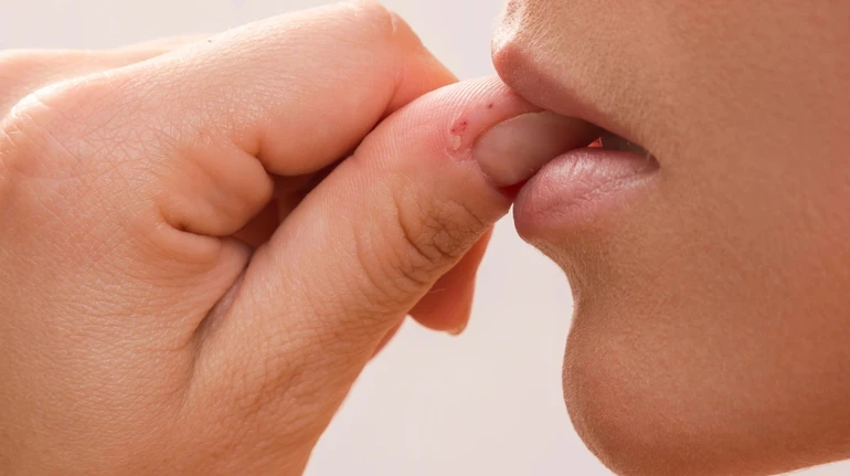 Гризете нігті чи кусаєте губи? Що ховається за нервовою звичкою і як це припинити – пояснюють медики