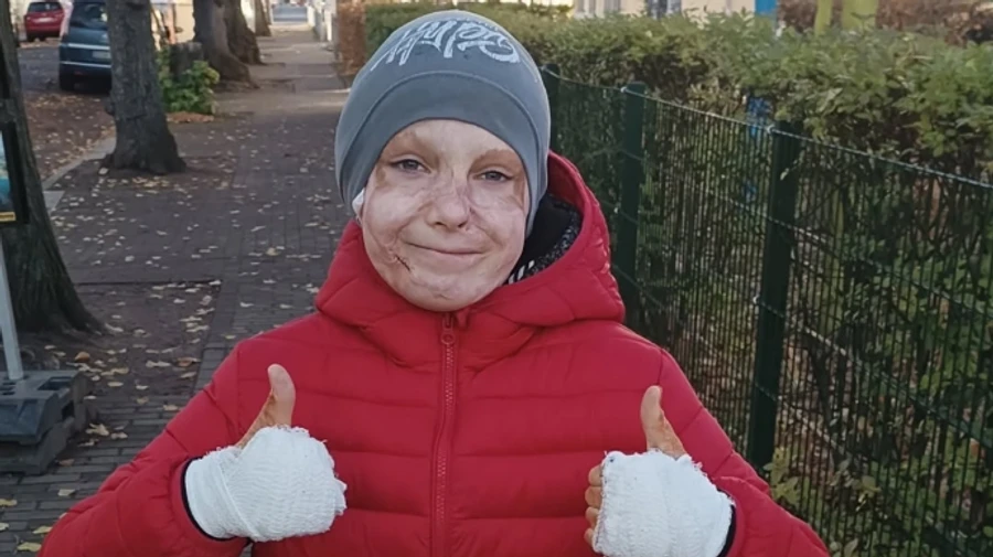 Boy who survived Russian missile attack on Vinnytsia takes off scar treatment mask he wore for two years – photo