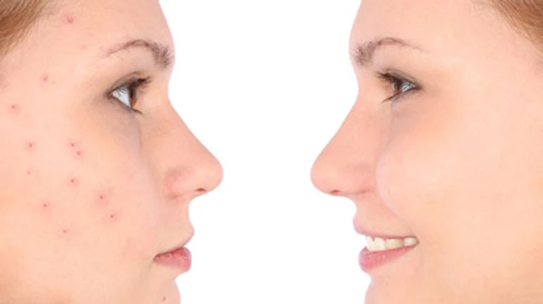 От же ж ці прищі! Акне, вугрі та засоби від них. ПОДКАСТ з дерматологом