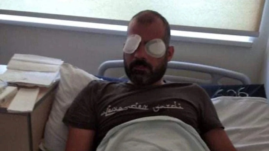 В Грузии ослеп на один глаз оператор, избитый во время акции против ЛГБТ-марша