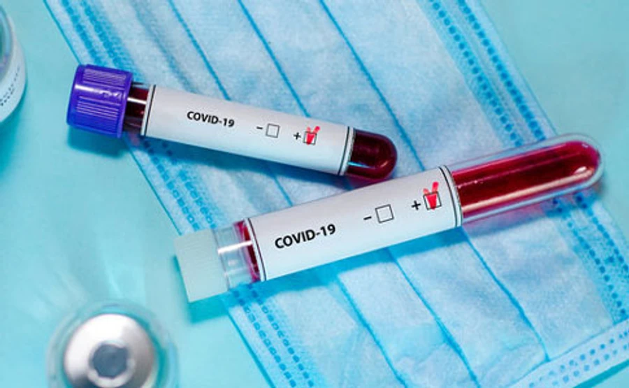 В Житомирской области – 6 положительных тестов на СOVID-19