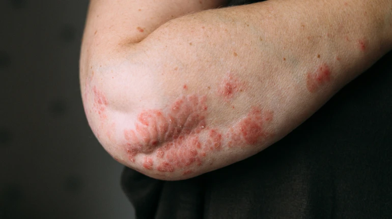 10 мифов о псориазе: можно ли им заразиться и полностью вылечить?