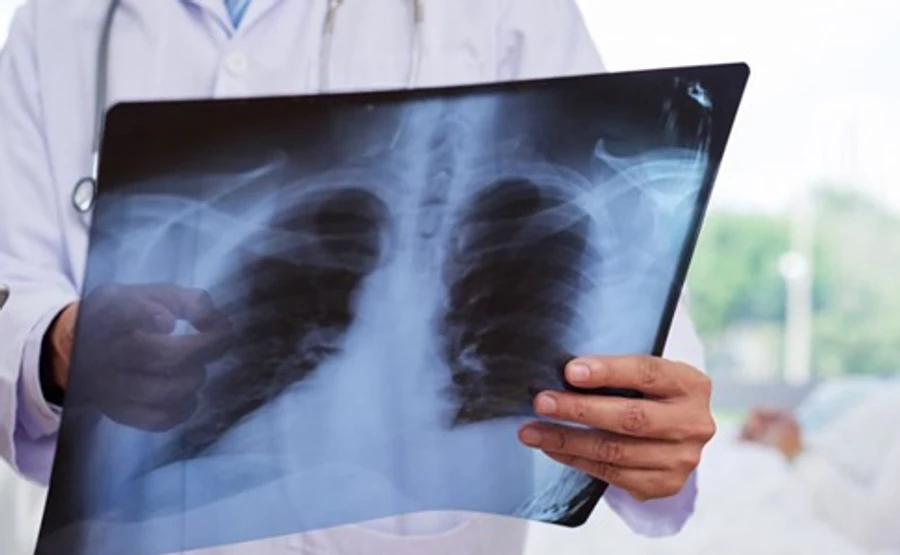 В ОРДЛО майже 150 осіб - з пневмонією, можливості діагностувати коронавірус немає 