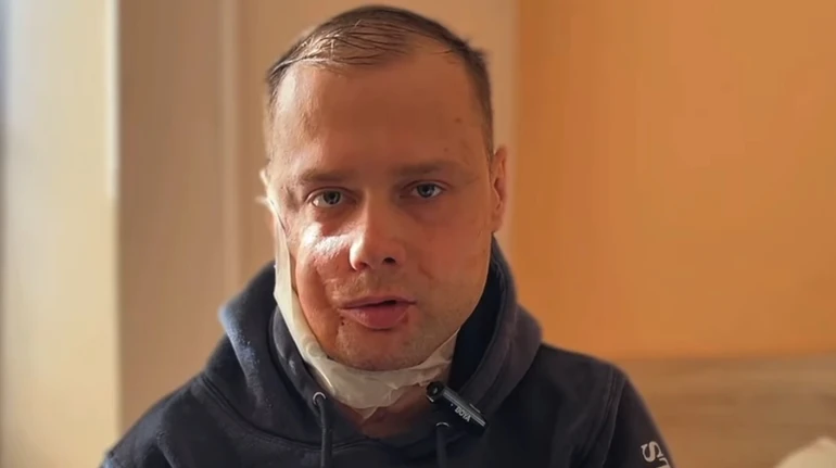 У Львові лікарі реконструювали обличчя ветерану, який з дитинства не міг жувати через травму