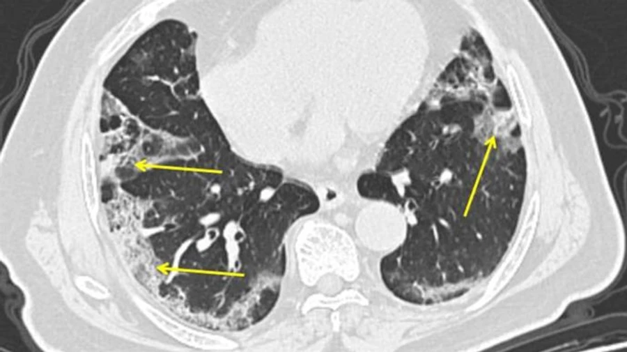 За тиждень МОЗ зафіксувало 22,4 тисячі пневмоній