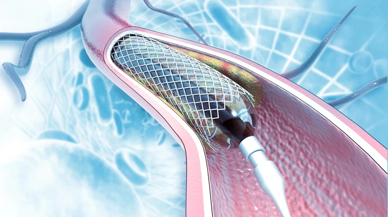 Стентування судин серця в Україні стало безкоштовним: у МОЗ розповіли, як отримати послугу