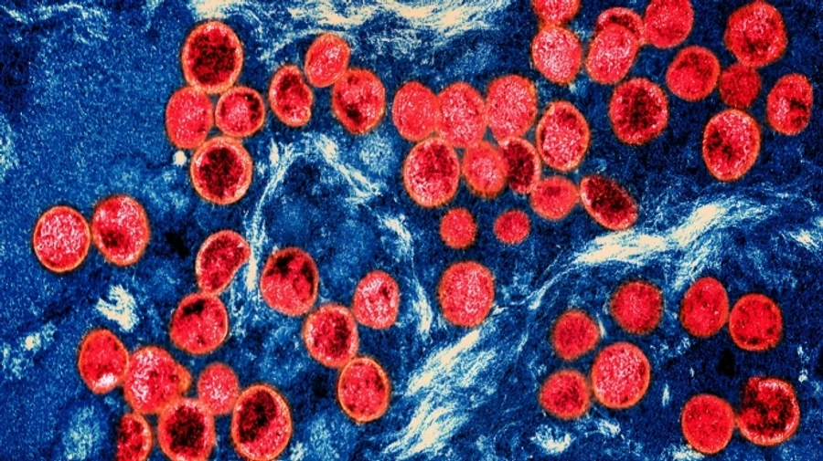 ВООЗ оголосила глобальну надзвичайну ситуацію через спалах віспи мавп