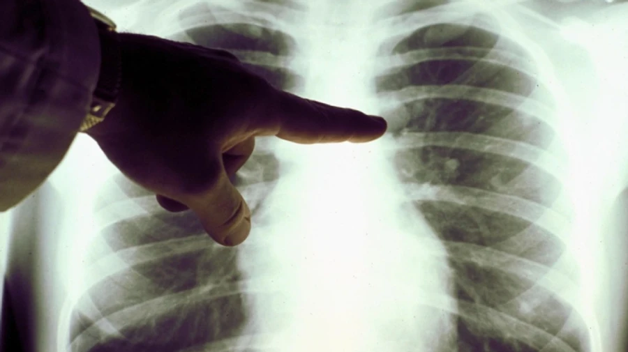 В Киеве растет количество больных пневмонией – Кличко