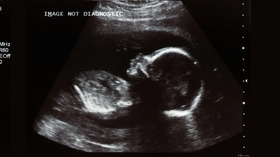 COVID-19 може передаватися внутрішньоутробно — дослідження