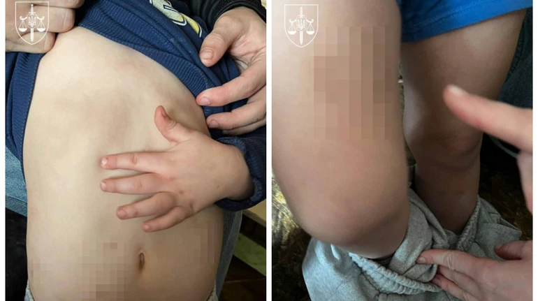 На Київщині засудили чоловіка, який бив дітей своєї співмешканки: у них виявили численні гематоми