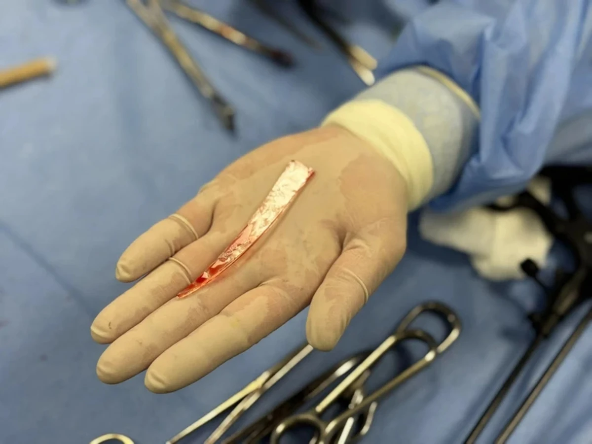 A 10 centimetre shard was removed from his lung