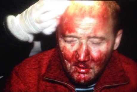 Во время разгона митинга на Банковой 1 декабря мужчине разбили голову. Фото Мустафы Найема Во время разгона митинга на Банковой 1 декабря мужчине разбили голову. Фото Мустафы Найема