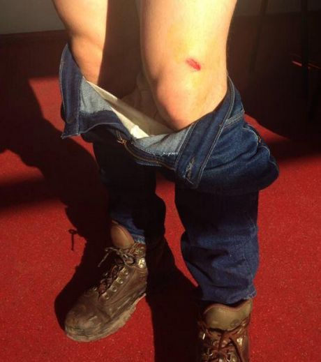 Видеографа Громадського ТБ ранило в ногу