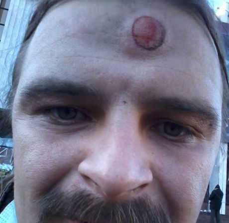 Журналіст Олексій Бик - із гулею від кулі Журналіст Олексій Бик - із гулею від кулі