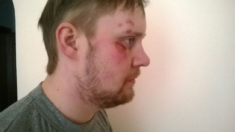 Перфільєв опублікував фотографії свого побитого оператора. Фото з блогу kitubijca.livejournal.com Перфільєв опублікував фотографії свого побитого оператора. Фото з блогу kitubijca.livejournal.com