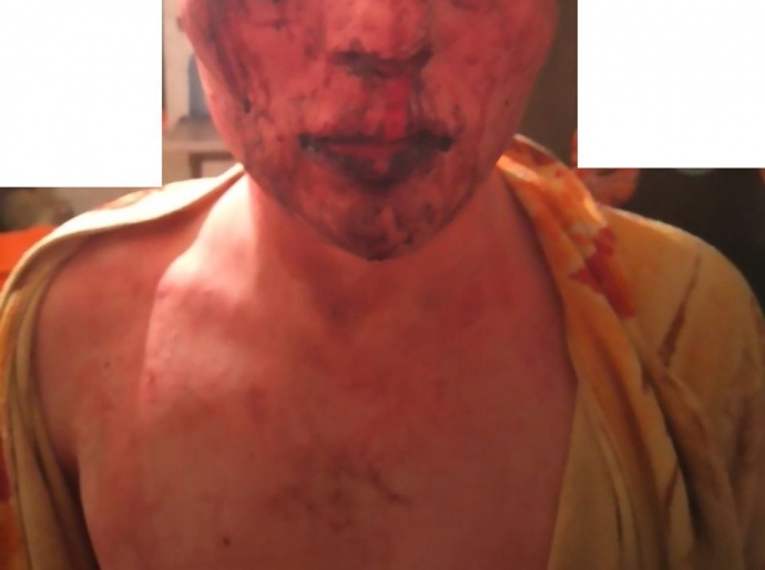 Побитий у Житомирі трансгендер